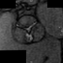 A severely stenotic aortic valve displayed in a cardiac MRI