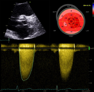 The high risk echocardiographic features of severe aortic stenosis
