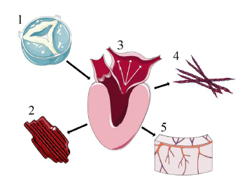 Illustration of the impact of aortic stenosis on the heart